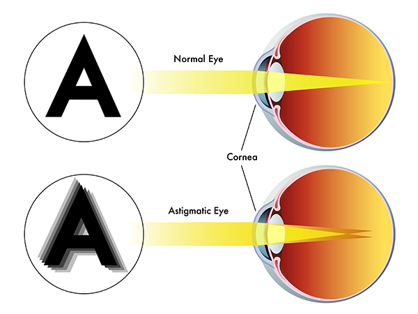 diagram showing the difference between normal and astigmatic eye