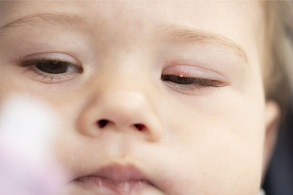 baby boy with milia on his eye lid
