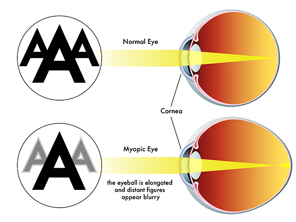 Diagram showing difference between normal and myopic eye