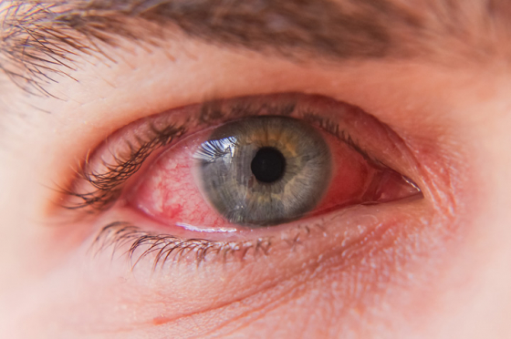 Close up of an eye with conjunctivitis symptoms